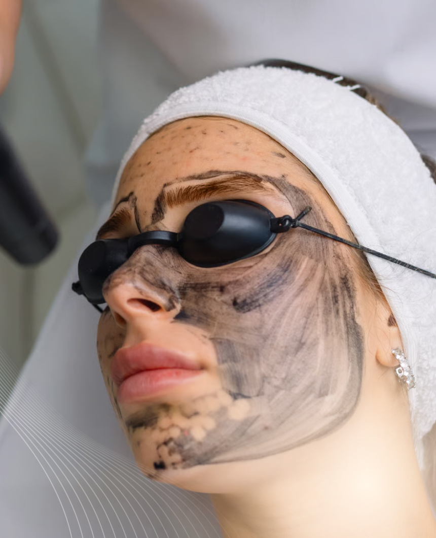 Hollywood peel en Monterrey: mascarilla de carbón activado antes del láser